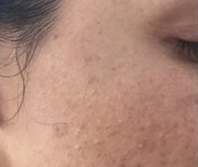 Antes